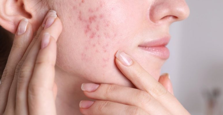 Bị nám do nội tiết tố? Giải pháp tự nhiên hiệu quả & an toàn