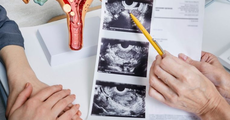 Bị u nang buồng trứng có kinh nguyệt không? Giải đáp chi tiết!